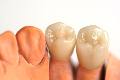 Dental Crowns in Corona