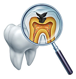 Dental Decay Treatment in Corona