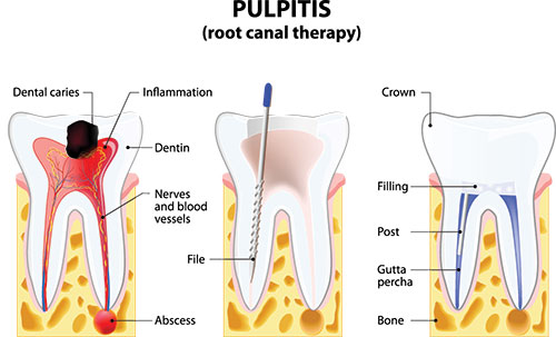 Corona Root Canal Treatment